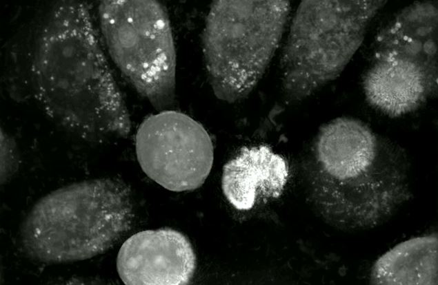 Nanolive technology reveals ferroptosis execution in an aggressive human prostate cancer model