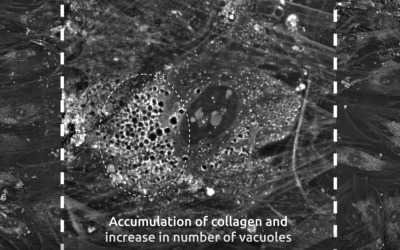 Chondrogenic differentiation of mesenchymal stem cells imaged live, using Nanolive’s label-free, non-invasive imaging
