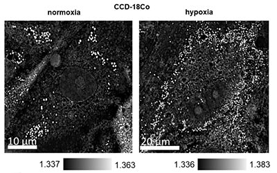 A new diagnostic role for Nanolive’s refractive index imaging?