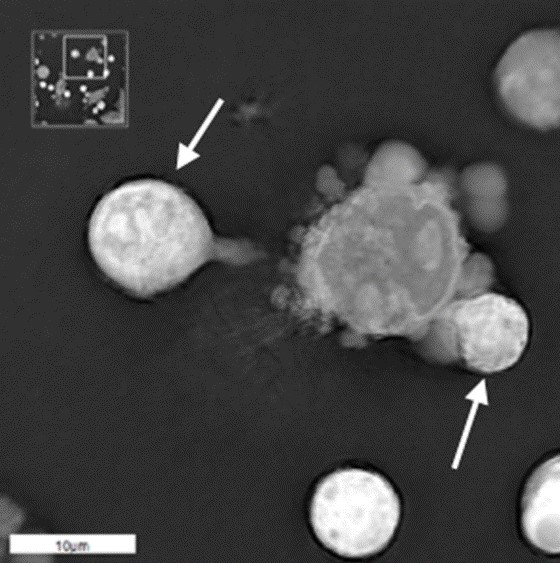 Neutrophils are mediators of metastatic prostate cancer progression in bone